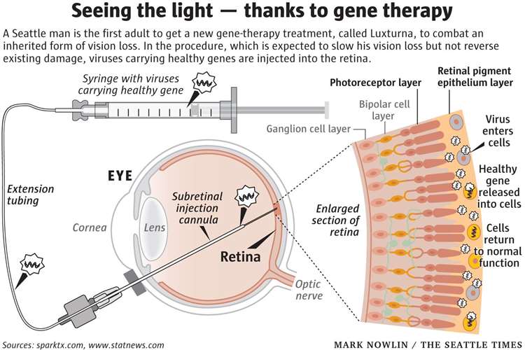 How Luxturna, a gene therapy from Spark Therapeutics, works (12992879)